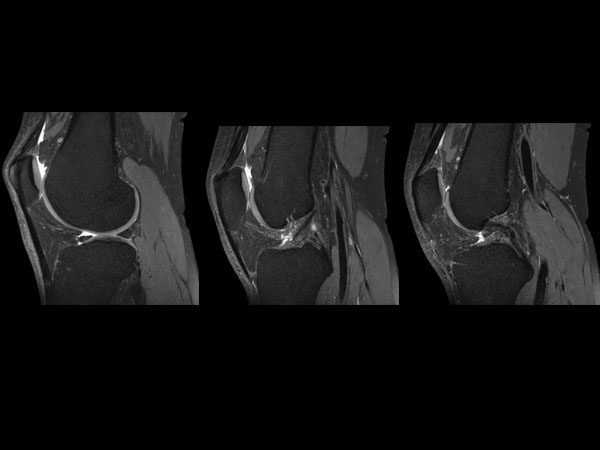 Sagittal PDw SPAIR MSK View dS SENSE = 4.4