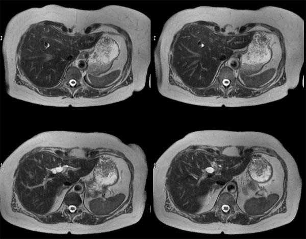 SSh T2w TSE dS- SENSE = 3
