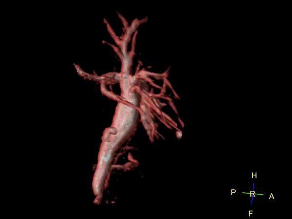 3D MRCP (Volume Rendering)