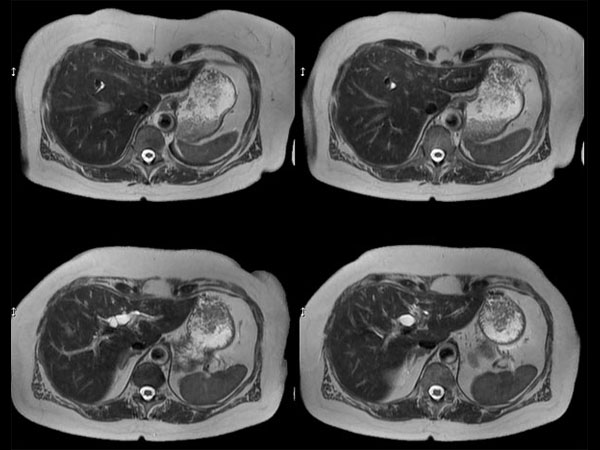 SSh T2w TSE dS- SENSE = 3