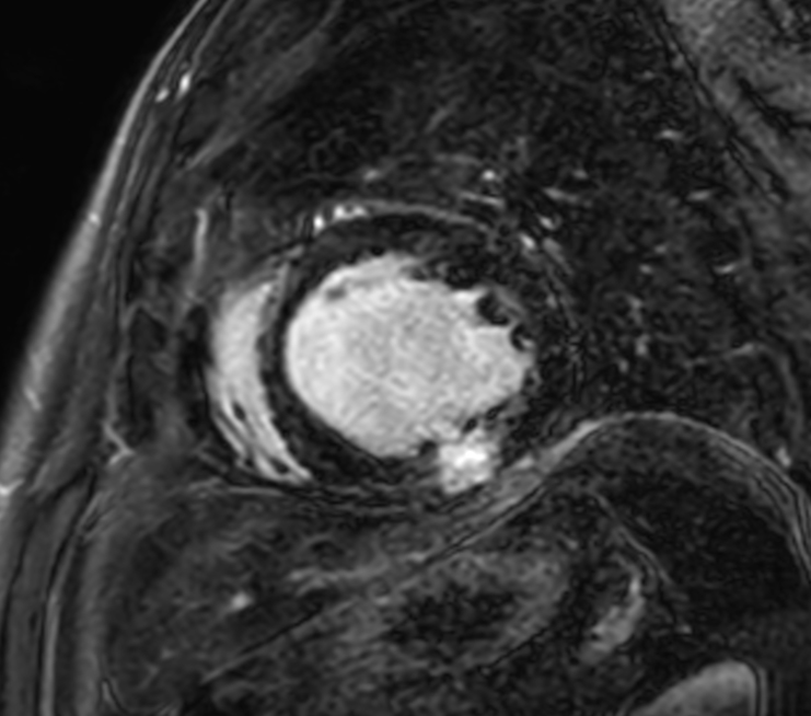 3D SPIR VI, short axis view
