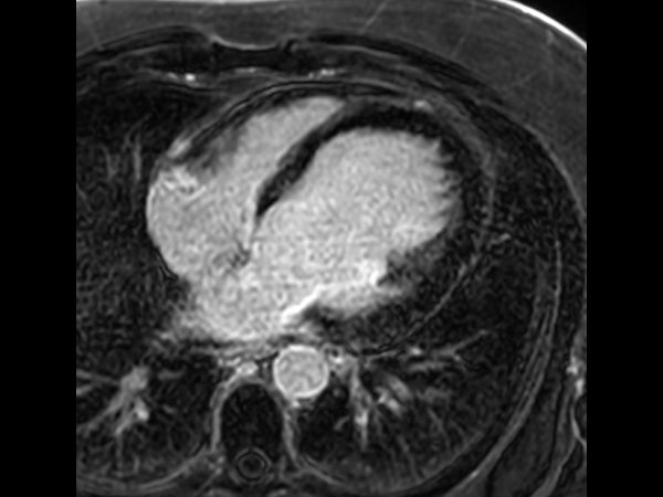 3D SPIR VI, axial view                       