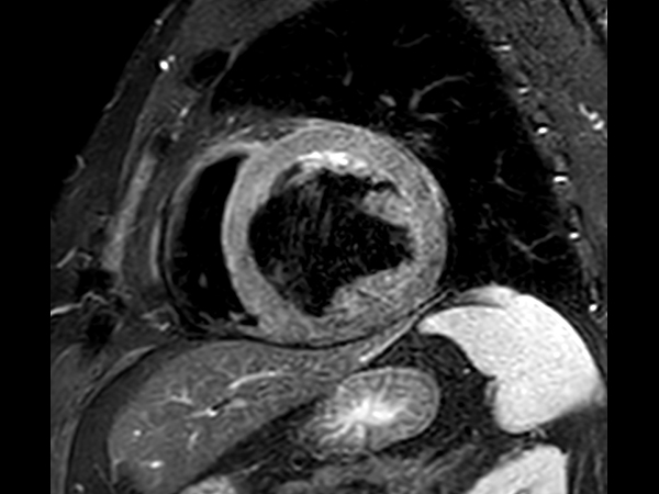 T2 STIR Black Blood, short axis view, without Compressed SENSE