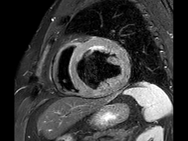 T2 STIR Black Blood, short axis view, with Compressed SENSE