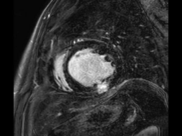 3D SPIR VI, short axis view