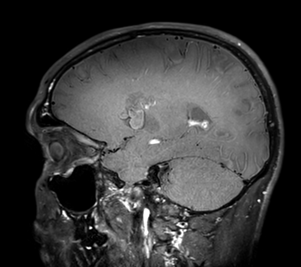 3D VIEW - T1w Black Blood