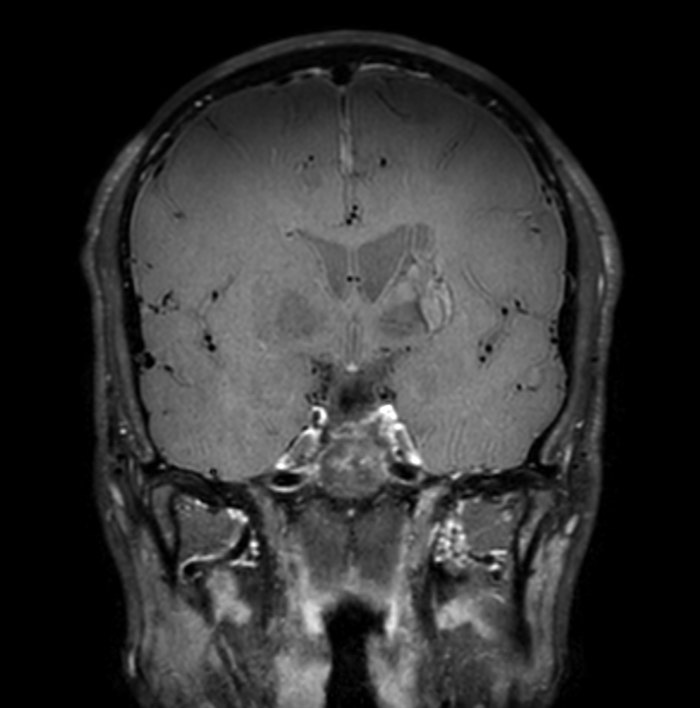 3D VIEW - T1w Black Blood