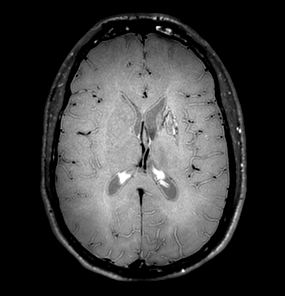 3D VIEW - T1w Black Blood