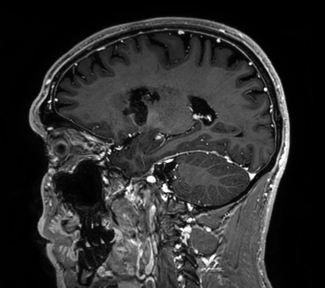 3D T1w TFE (post-gado)