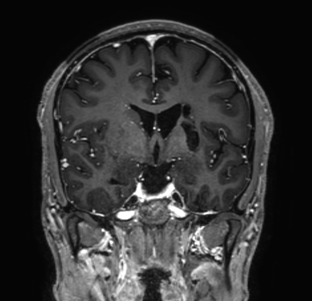 3D T1w TFE (post-gado)