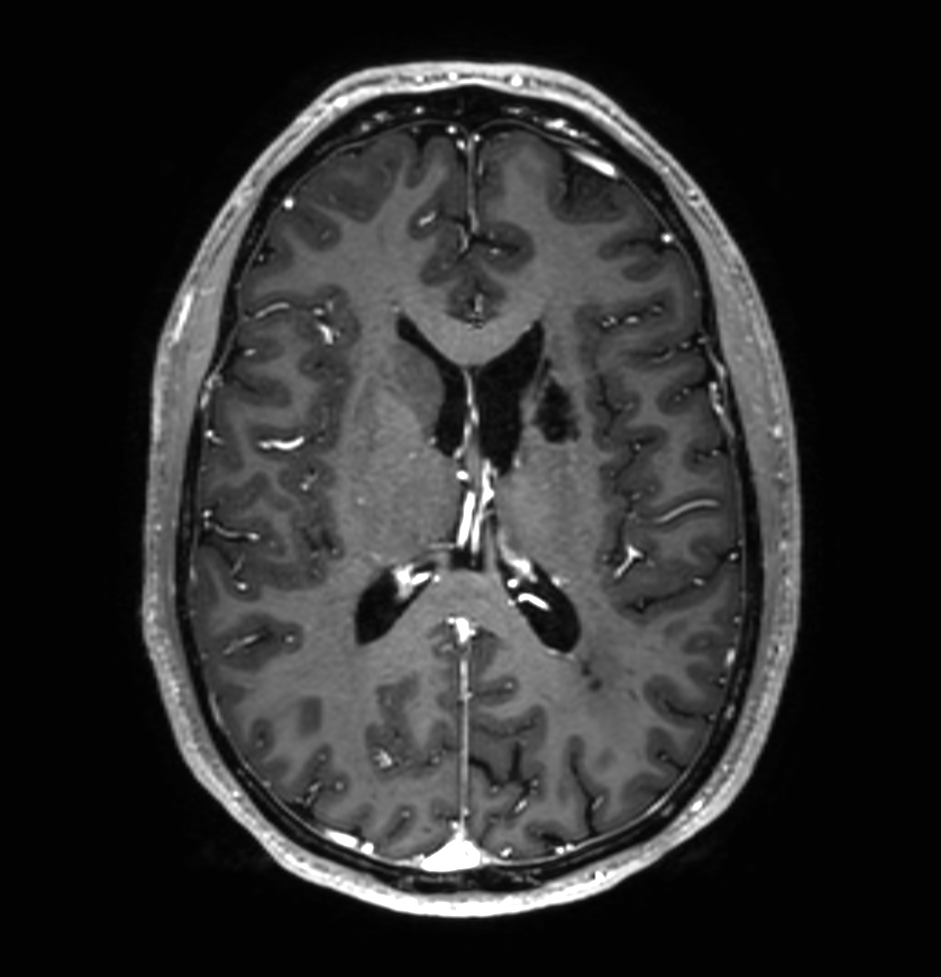 3D T1w TFE (post-gado)