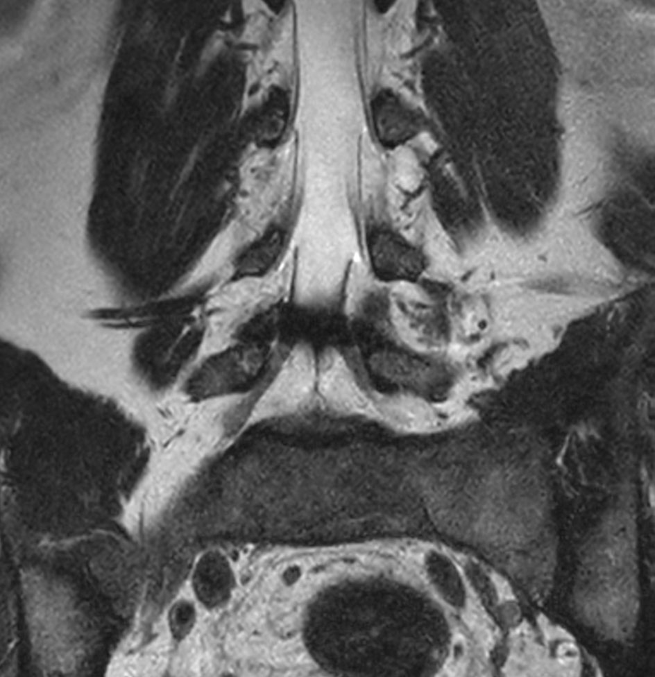 Coronal T2w mDIXON XD TSE (In-Phase)
