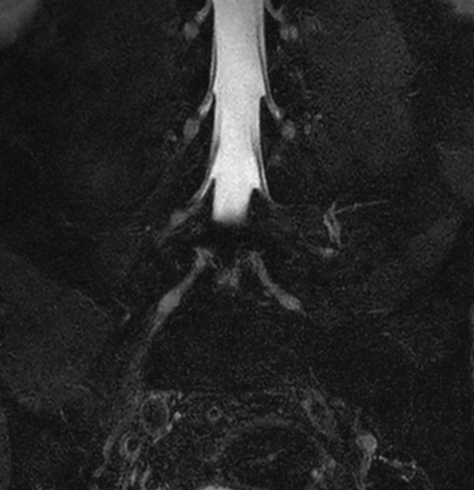 Coronal T2w mDIXON XD TSE (Water only)