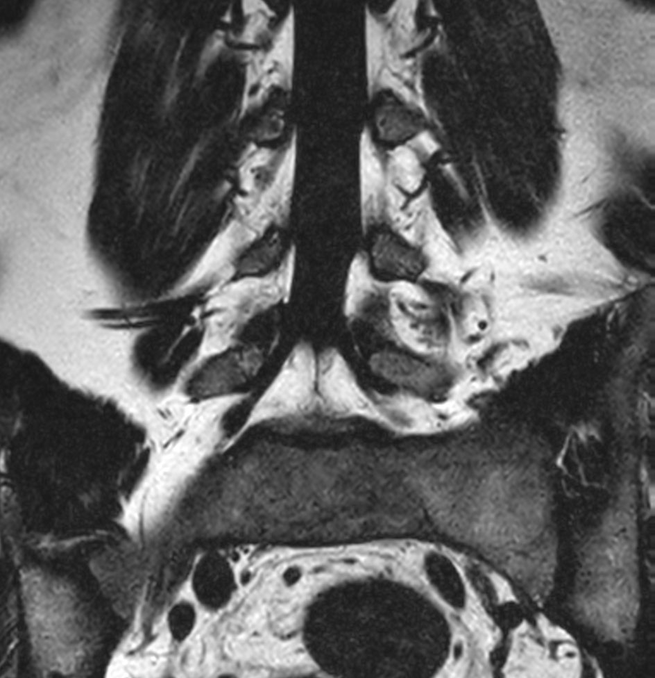 Coronal T2w mDIXON XD TSE (fat only)