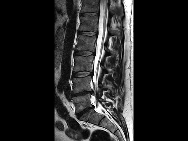 Sagittal T2w TSE