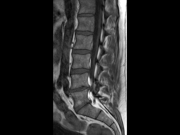 Sagittal T1w TSE