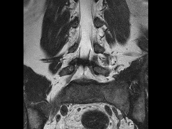 Coronal T2w mDIXON XD TSE (In-Phase)