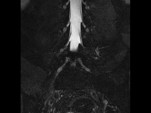 Coronal T2w mDIXON XD TSE (Water only)