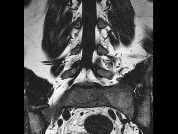 Coronal T2w mDIXON XD TSE (fat only)