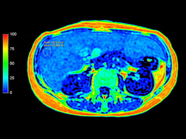 mDIXON Quant (fat fraction map)