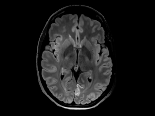 3D FLAIR (axial reformat)