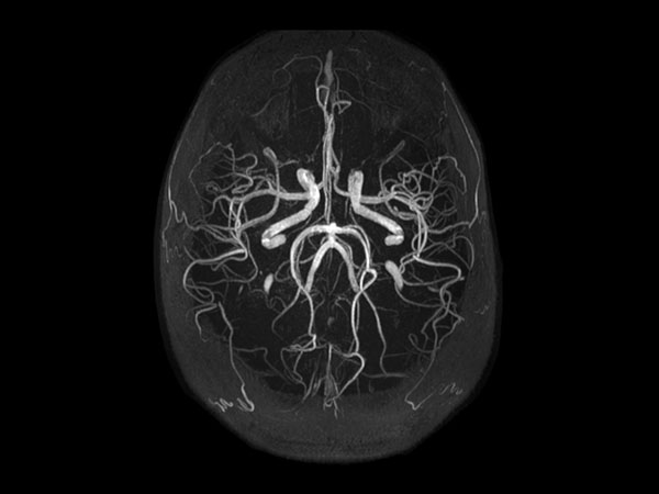 Inflow Angiography