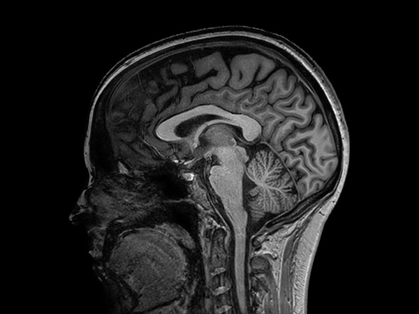 Sagittal 3D T1w TFE