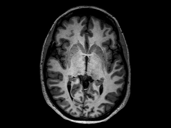 3D T1w TFE (axial reformat)