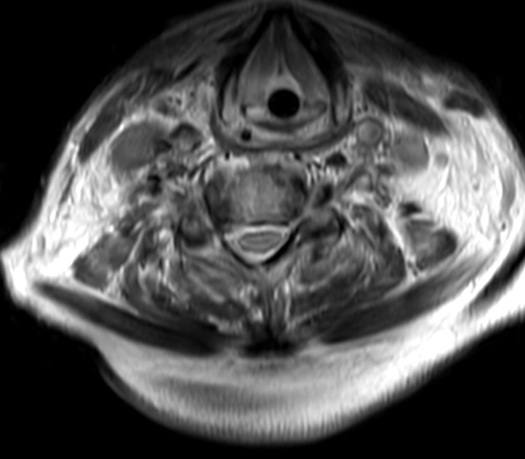 T2w TSE 3D (52 slices)