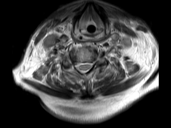 T2w TSE 3D (52 slices)