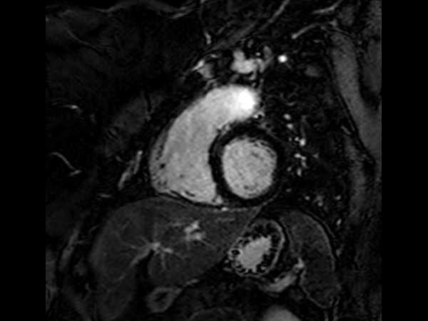 2D VI SSh, short axis view