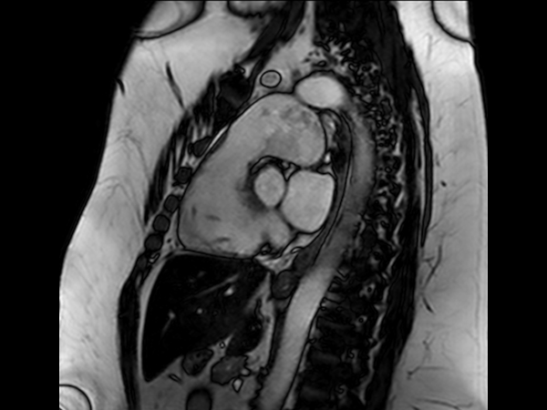 bTFE, RVOT view