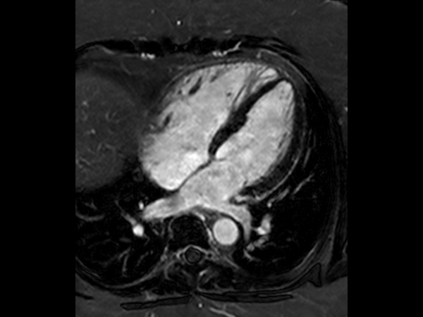 2D VI, 4 chamber view