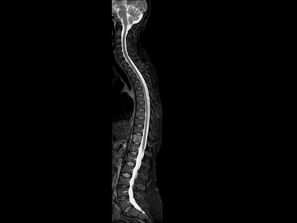 Sagittal T2w TSE mDIXON (water)