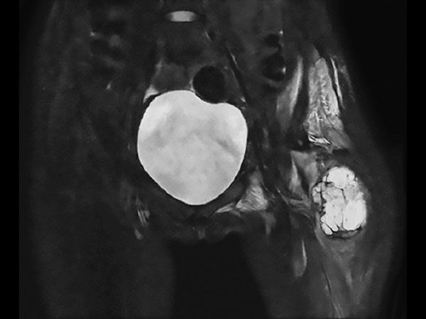 Coronal T2w TSE mDIXON (water only)