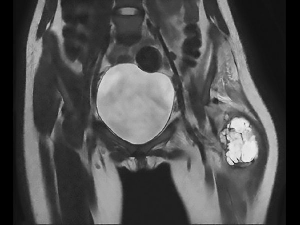 Coronal T2w TSE mDIXON (in-phase)