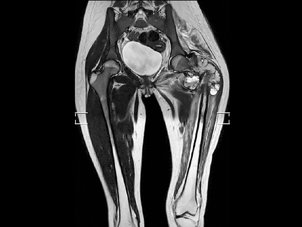 Coronal T2w TSE mDIXON (in-phase, MobiView)