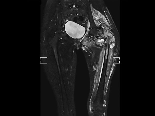 Coronal T2w TSE mDIXON (water only, MobiView)