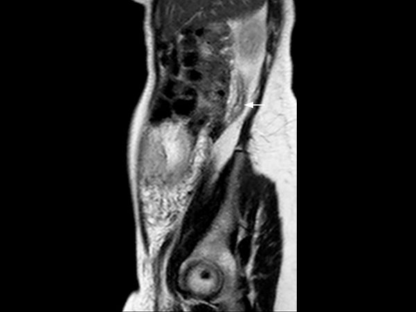 Sagittal T2w TSE