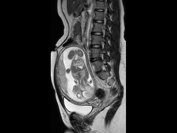 Sagittal T2w TSE