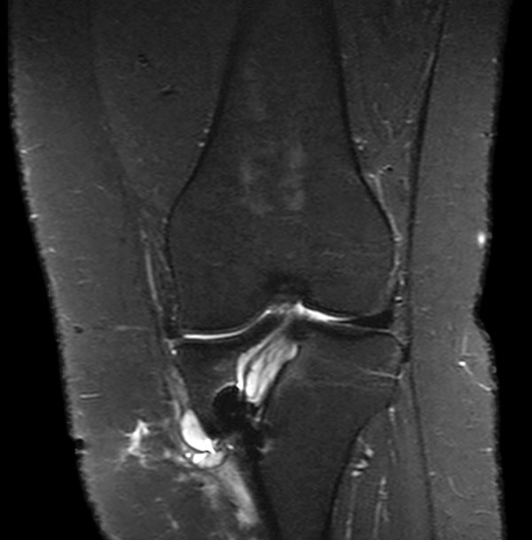 Coronal STIR aTSE (MARS)