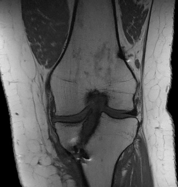 Coronal T1w TSE (MARS)