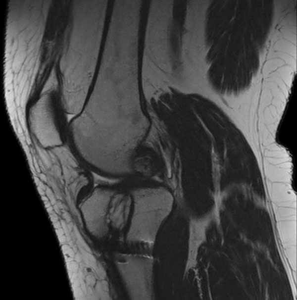 Sagittal T2w TSE (MARS)