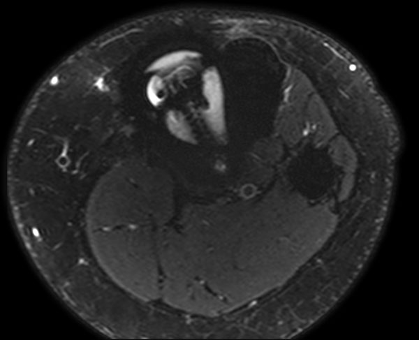 Axial T2w SPAIR (MARS)