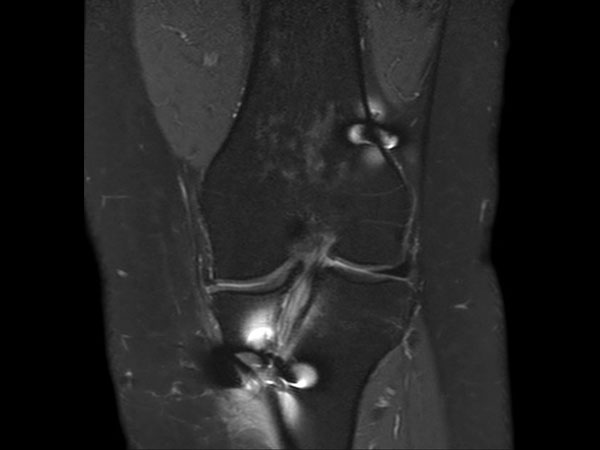 Coronal PDw SPAIR