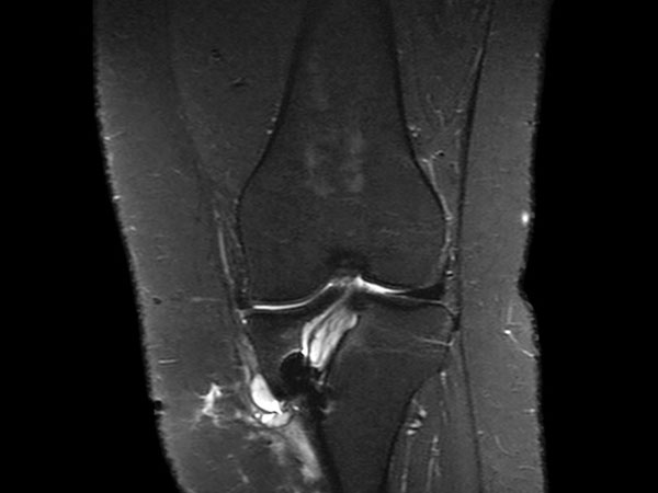 Coronal STIR aTSE (MARS)