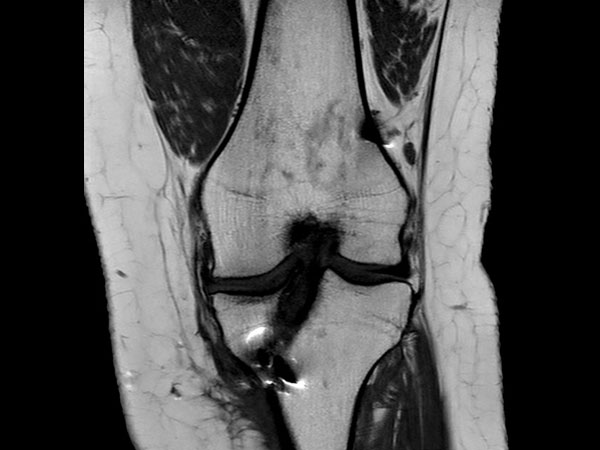 Coronal T1w TSE