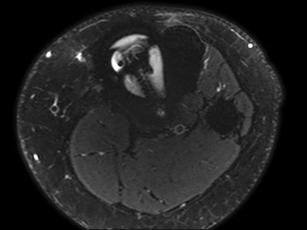 Axial T2w SPAIR (MARS)