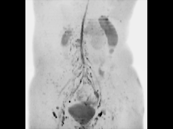 Coronal DWIBS (MIP) dS SENSE = 4, MobiView