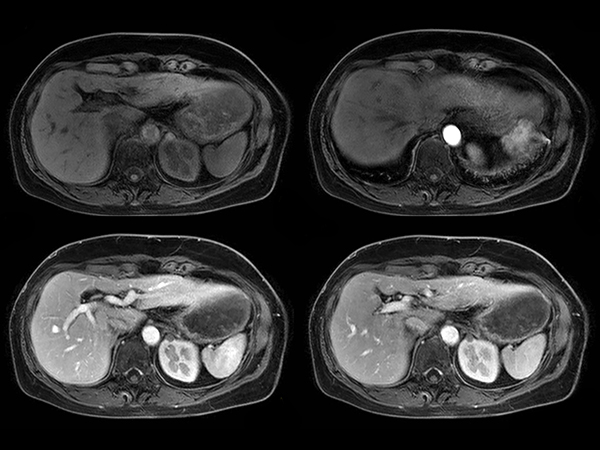 Axial dynamic mDIXON - Water dS SENSE = 7.5